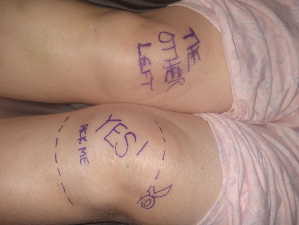 Doc told us to write yes on the knee to replace before surgery We took it further