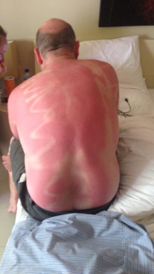 Forgot to rub in the spray-on sunscreen