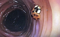 Ladybug found during colonoscopy