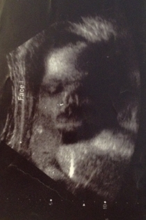 My babys ultrasound pic looks like Voldemort in utero