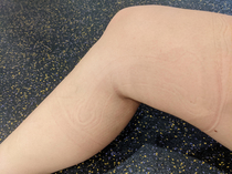 My brace leaves an interesting imprint on my leg
