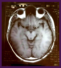 My cerebrum MRI resembles the Grinch