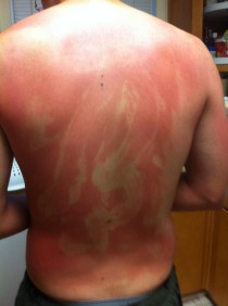 My husband just got back from a drunken camping trip with his friends This is why you dont let drunk friends apply your sunscreen