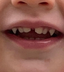 My kids teeth look like the Batman logo