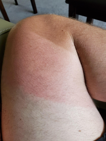 My Sunburn Out Here Looking Like a Tub of Neapolitan Ice Cream
