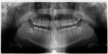 My wisdom tooth is an idiot