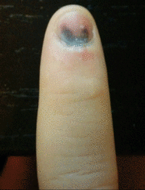 While moving a couch my finger got stuck between the wall and the couch Heres a timelapse of my nail healing