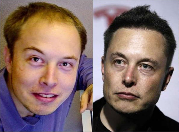  Elon Musk before and after Neuralink implants