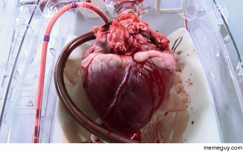 A heart as it awaits surgery 