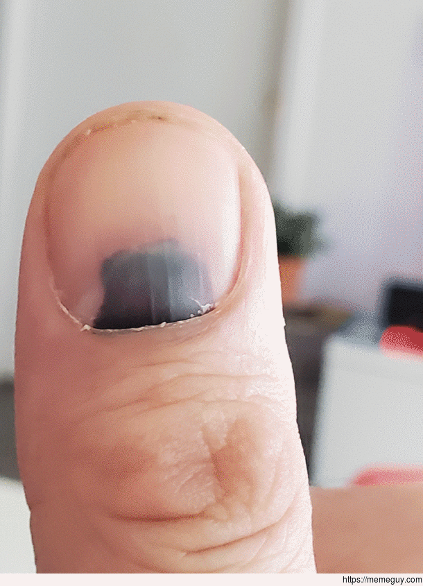 a  months time lapse of my finger nail ejecting trapped blood from a door meets finger accident