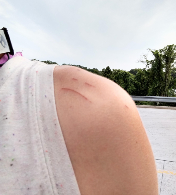 A puppy scratched my shouldermy shoulder was not happy