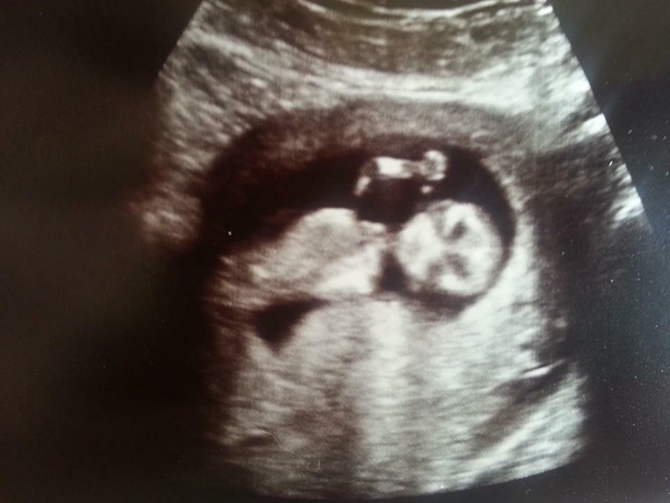 Apparently my wife is giving birth to Krillin from DBZ