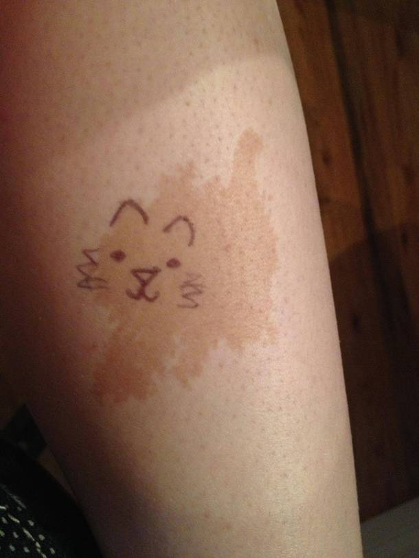 Birthmarks are being drawn on Heres mine