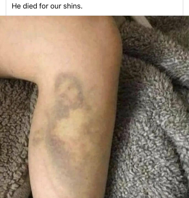 Bless be the contusion