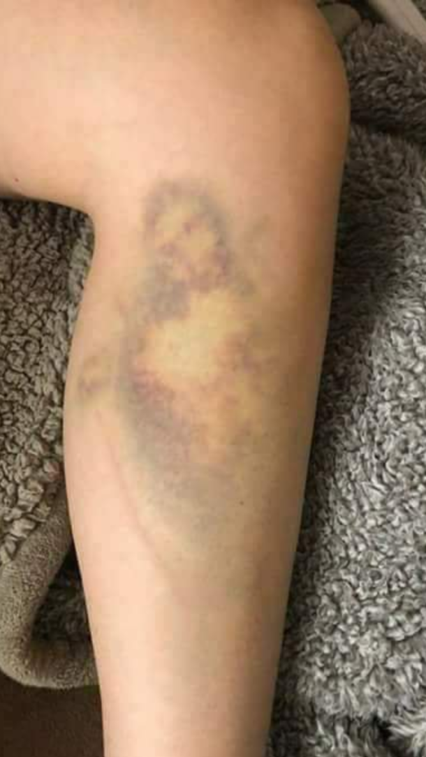 Christ appeared to me on a bruise