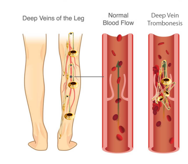 Deep Vein Trombonesis