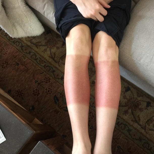 Heard were doing funny sunburns - my girlfriends legs after hiking her first er in Colorado