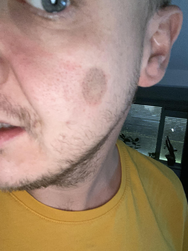 I fell asleep with a suction cup attached to my cheek this is day 