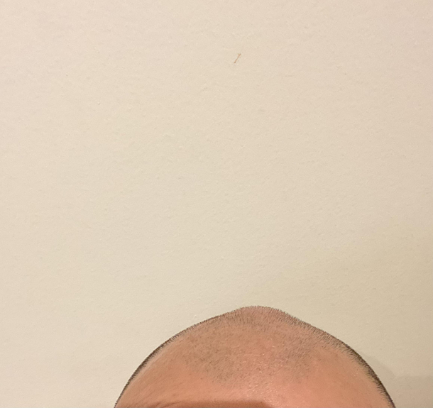 I got bit on the head and now I look like I was whacked in the head in a cartoon
