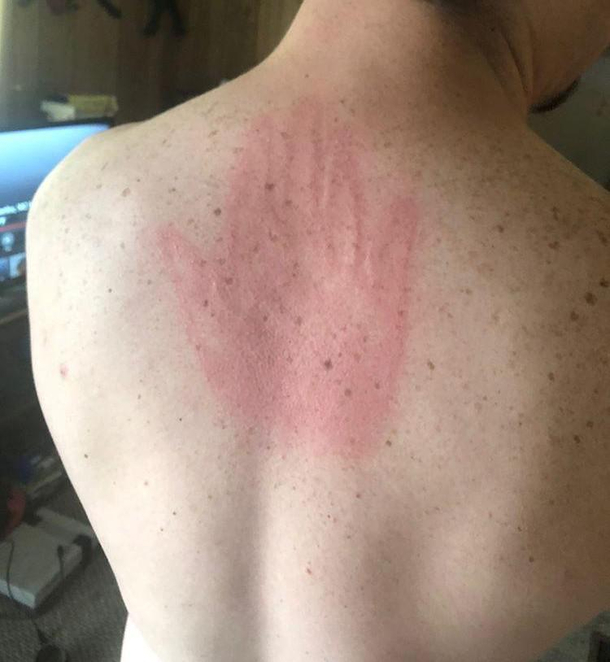 I playfully popped my girlfriend with a towel and wellshe got me back
