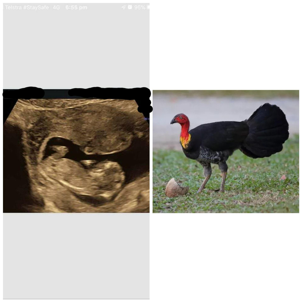I told my friend her ultrasound looks like a bush turkey