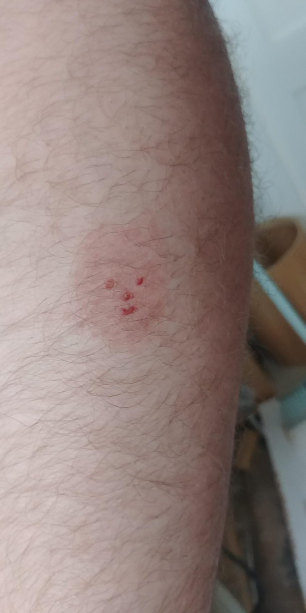 My burn must be healing nicely