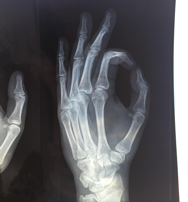 My friend fractured his thumb then sent me this he got me good