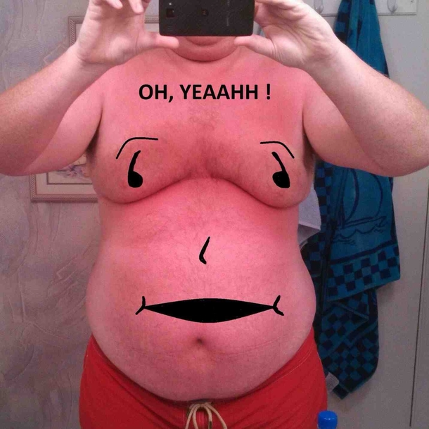 My friend sent a pic of his sunburn Couldnt resist
