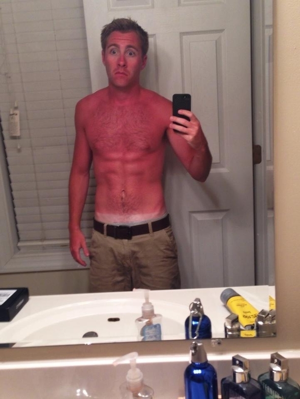 My friend should probably invest in sunscreen