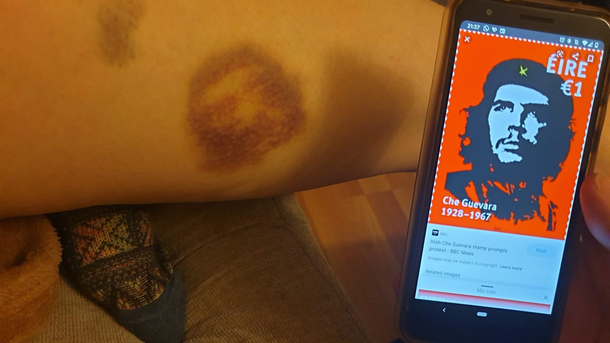 My friends bruise is ready for a communist revolution