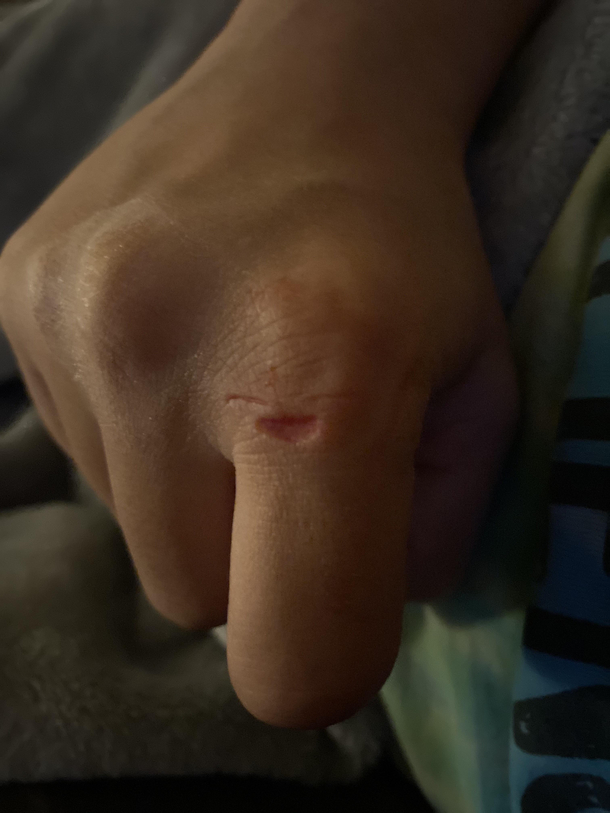 My wifes cut looks like a smiley face 
