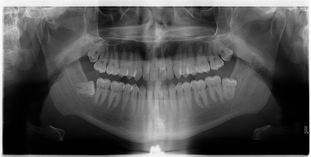 My wisdom tooth is an idiot