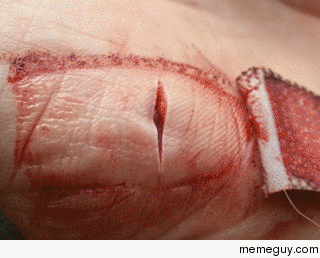 One photograph per day of a healing wound