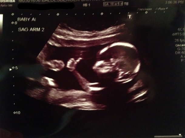 Recent ultrasound result looks good