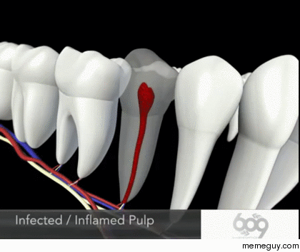 Root Canal Animation 
