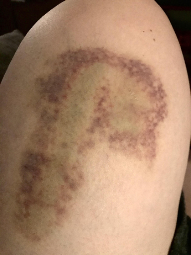 Tell me how I got this bruise