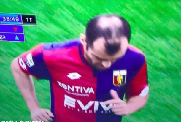 This balding pattern