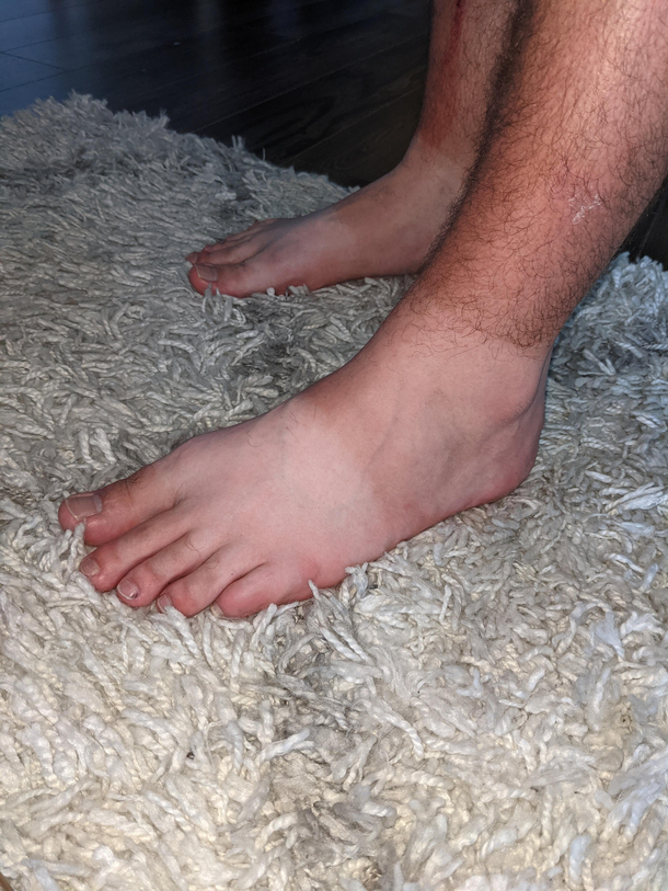 We call this the neapolitan sun tan Courtesy of my husbands foot