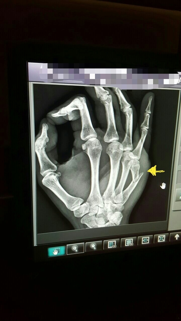 When the fractures just right