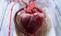 A heart as it awaits surgery 