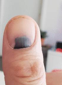 a  months time lapse of my finger nail ejecting trapped blood from a door meets finger accident