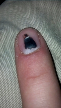 After smashing my finger in a door a while back Batman formed underneath my nail
