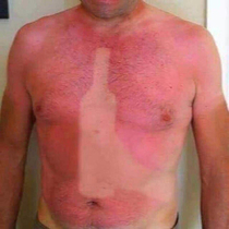 Best sunburn ever
