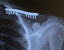I broke my collarbone and got surgery a little while back and I love looking at this image because it looks so fakeI didnt really know what subreddit to post this to