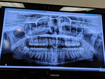 I got a panoramic xray of my teeth the other day The dentist forgot to have me remove my glasses