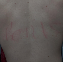I have dermatographia and my girlfriend sometimes likes to write on my back