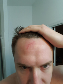 Joined a softball league first game ever got hit in the forehead by the ball