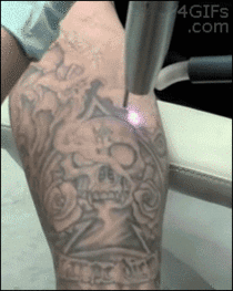 Laser tattoo removal