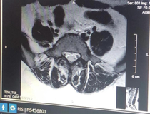 MRI of my lower back looks like a seal