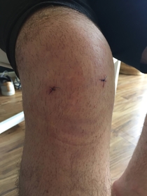 My boyfriends knee post surgery looks like a terrifying smiley face